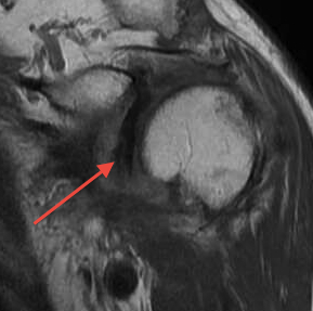 Biceps Tendon Medially Dislocated